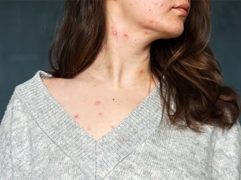 Treat Chickenpox with natural remedies, herbs and nutrients