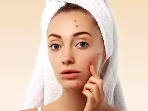 New Discovery May Lead To More Effective Acne Treatments