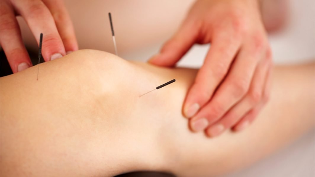 Suffering from Osteoarthritis? Acupuncture to the Rescue