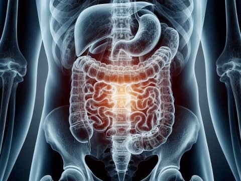 Ulcerative Colitis and Crohn’s Disease